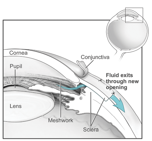 This diagram shows how the fluid from inside the eye<br />
flows out of the eye for a trabeculectomy surgery. This<br />
image is from the National Eye Institute Media Library.